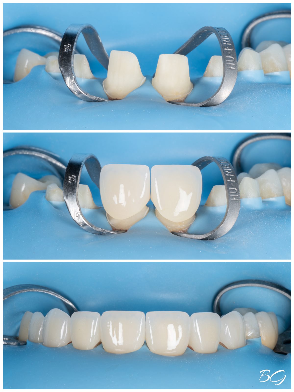 Dental crown preparation and completed treatment result