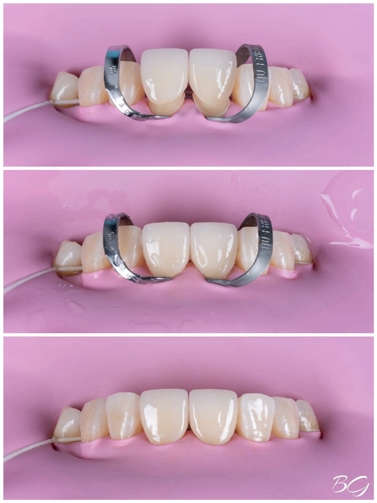 Second dental crown treatment result