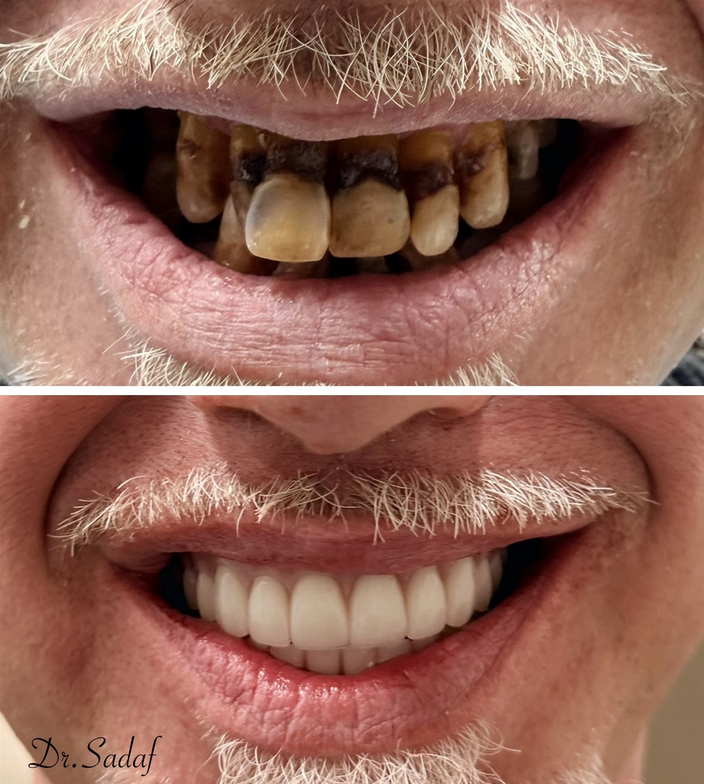Before and after full-mouth smile makeover