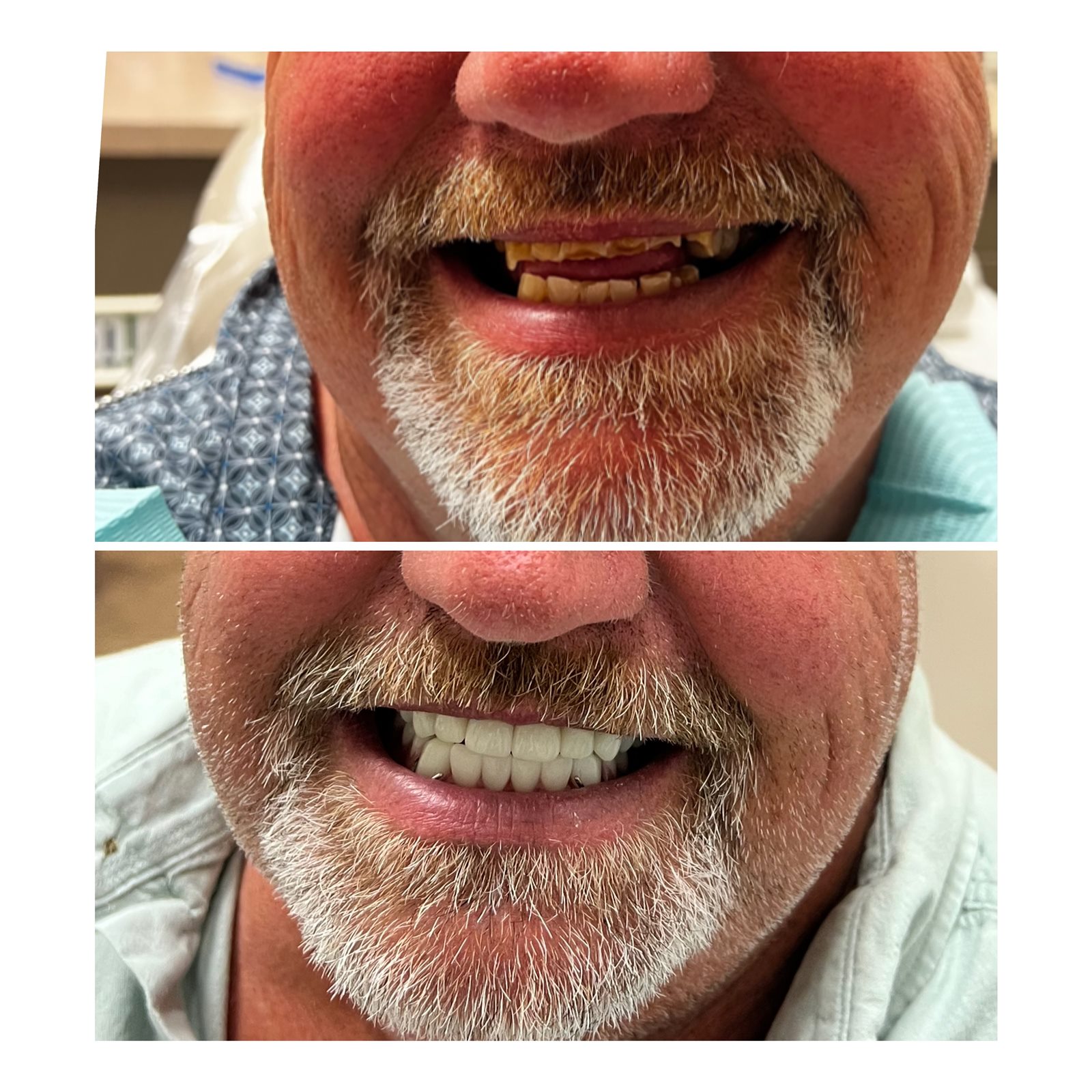 Second before and after full-mouth smile makeover