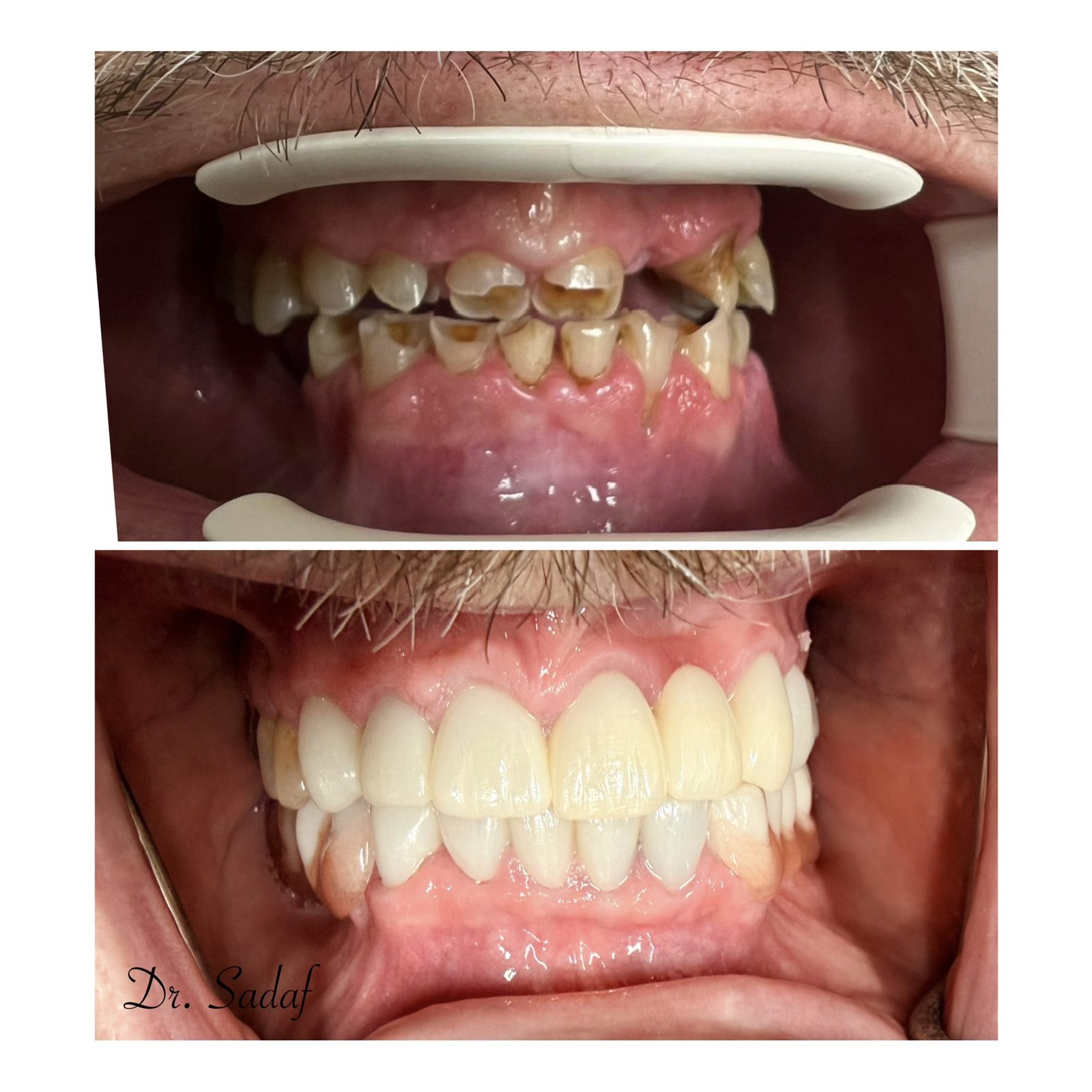 Third before and after full-mouth smile makeover