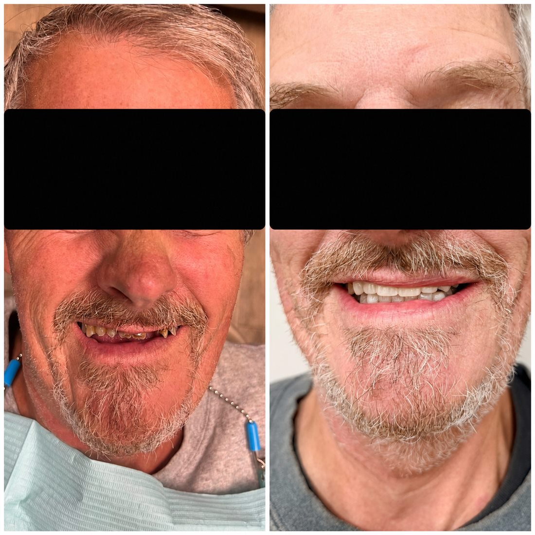 De-identified before and after full-mouth smile makeover with privacy bars