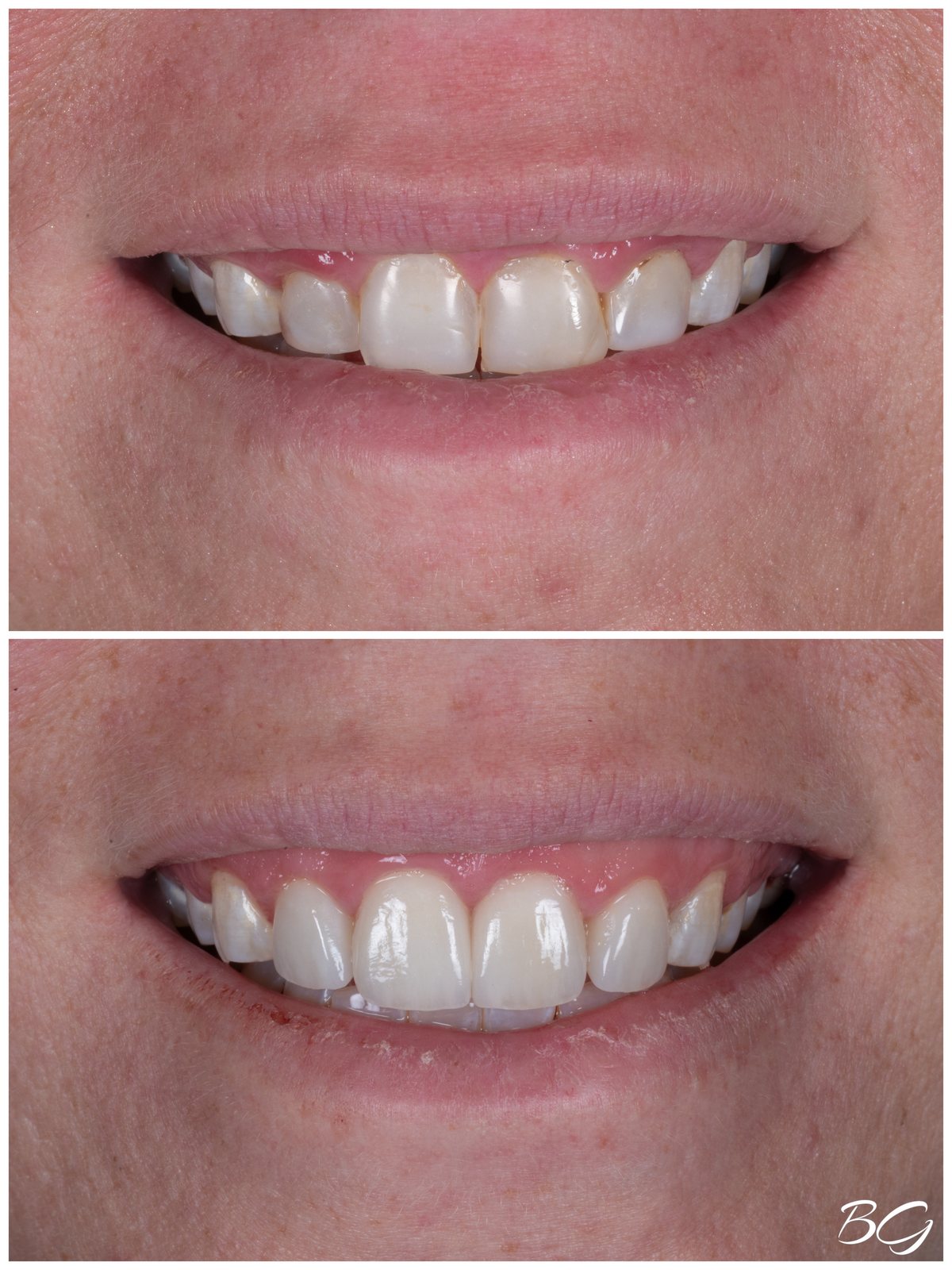 Eighth before and after porcelain veneer result