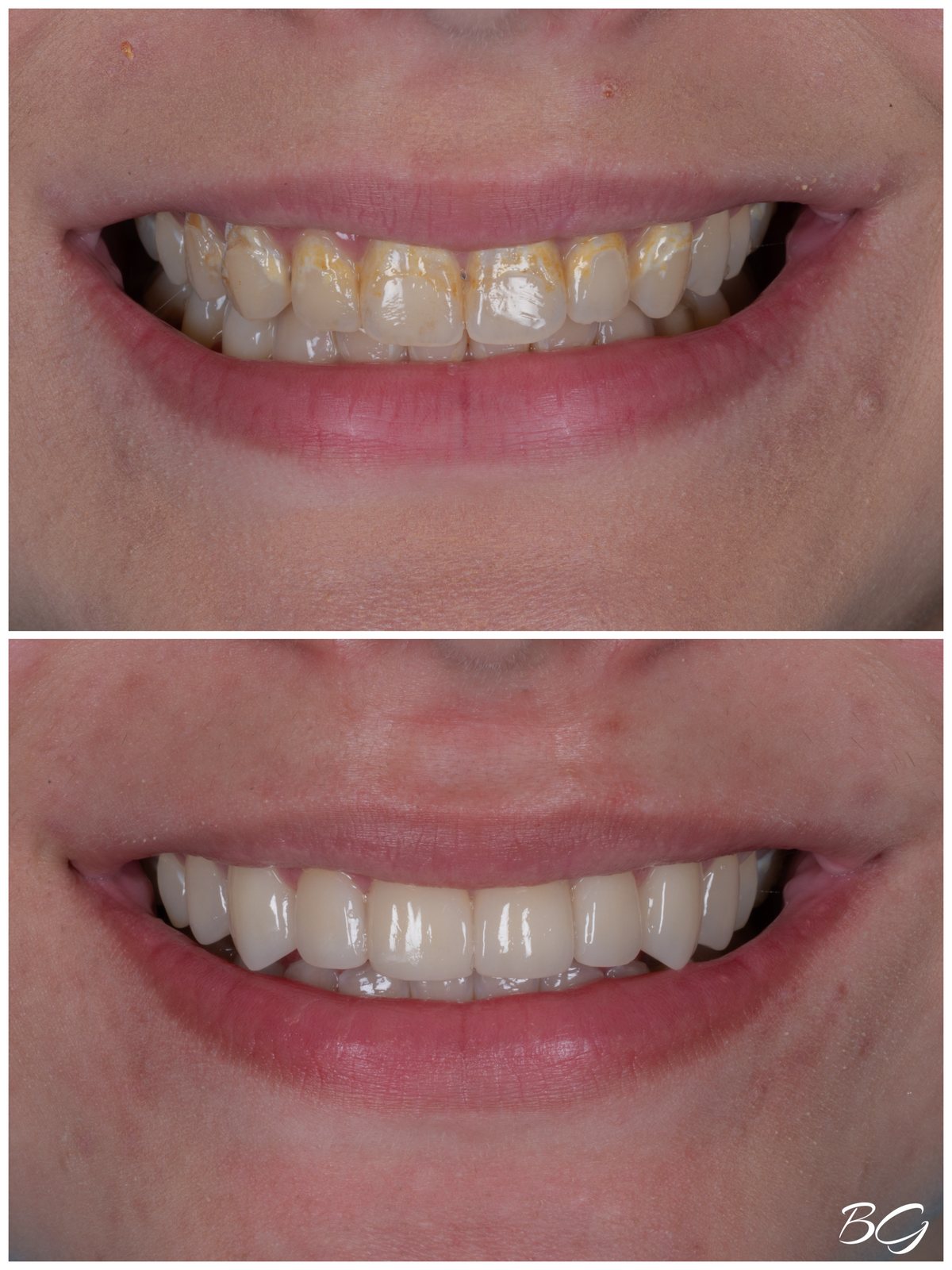 Ninth before and after porcelain veneer result