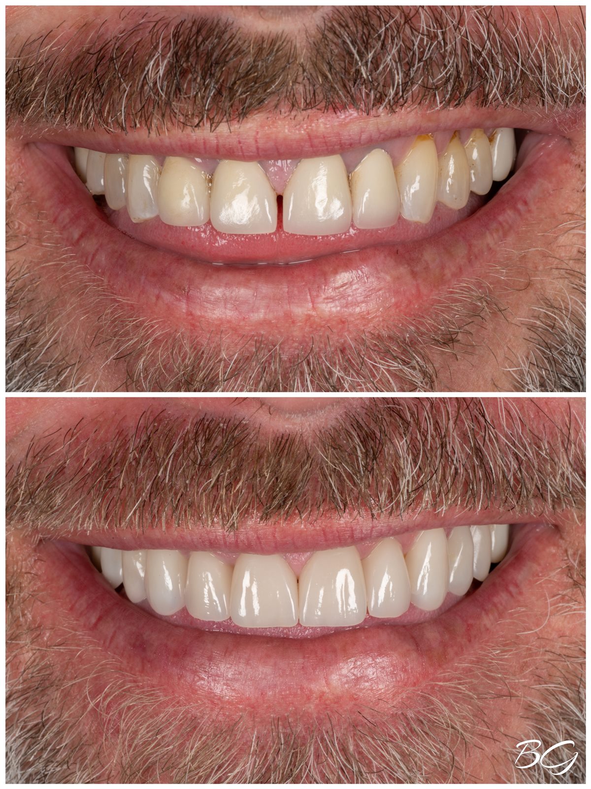 Second before and after porcelain veneer result