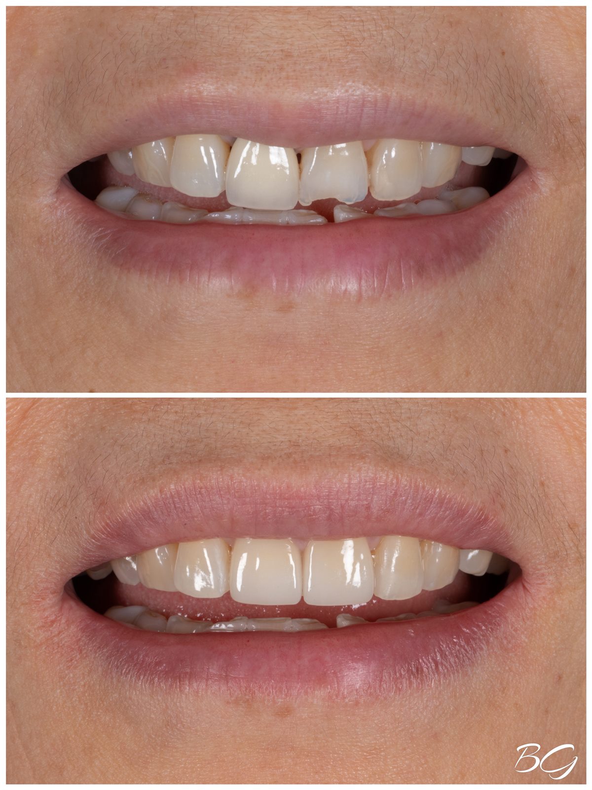 Third before and after porcelain veneer result