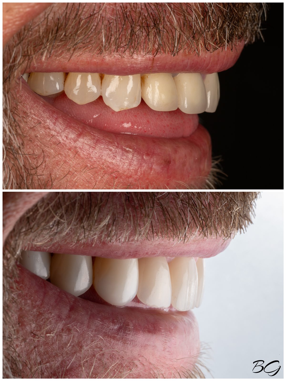 Fourth before and after porcelain veneer result