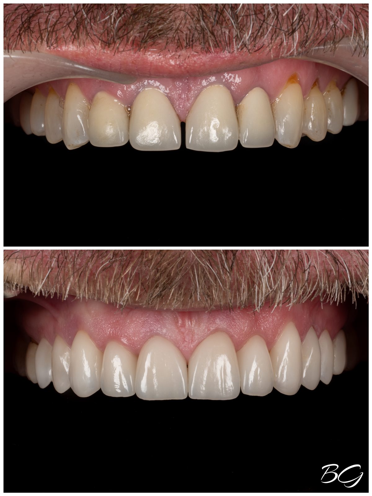Fifth before and after porcelain veneer result