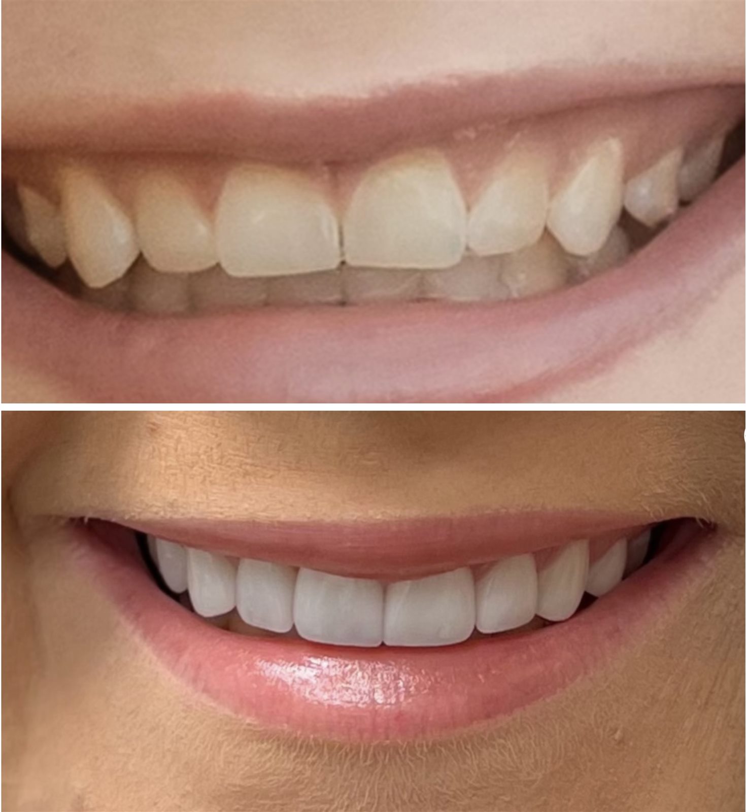 Before and after porcelain veneer result