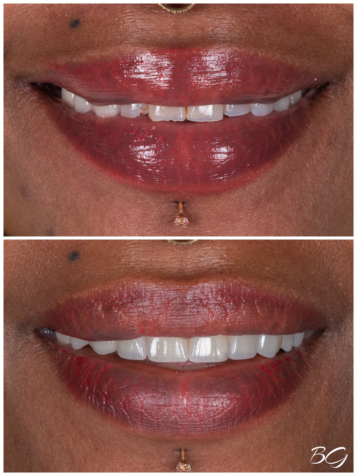 Sixth before and after porcelain veneer result