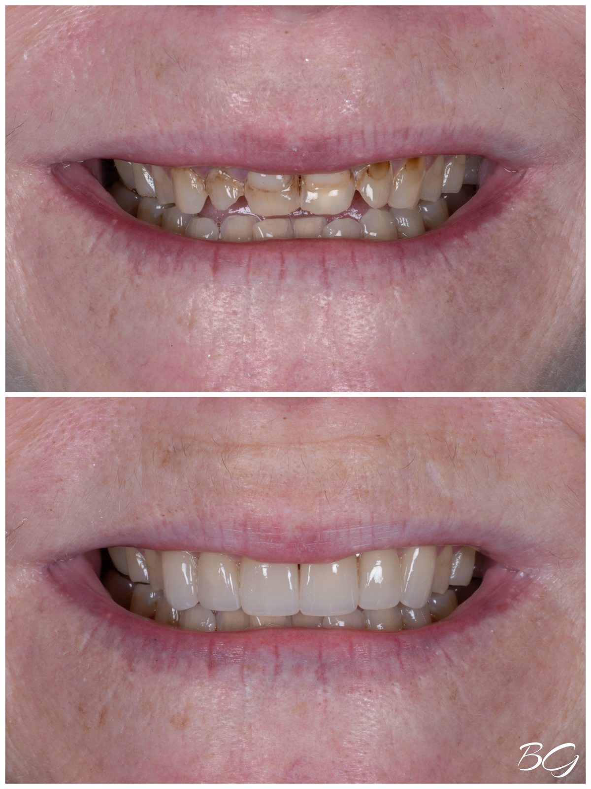 Seventh before and after porcelain veneer result