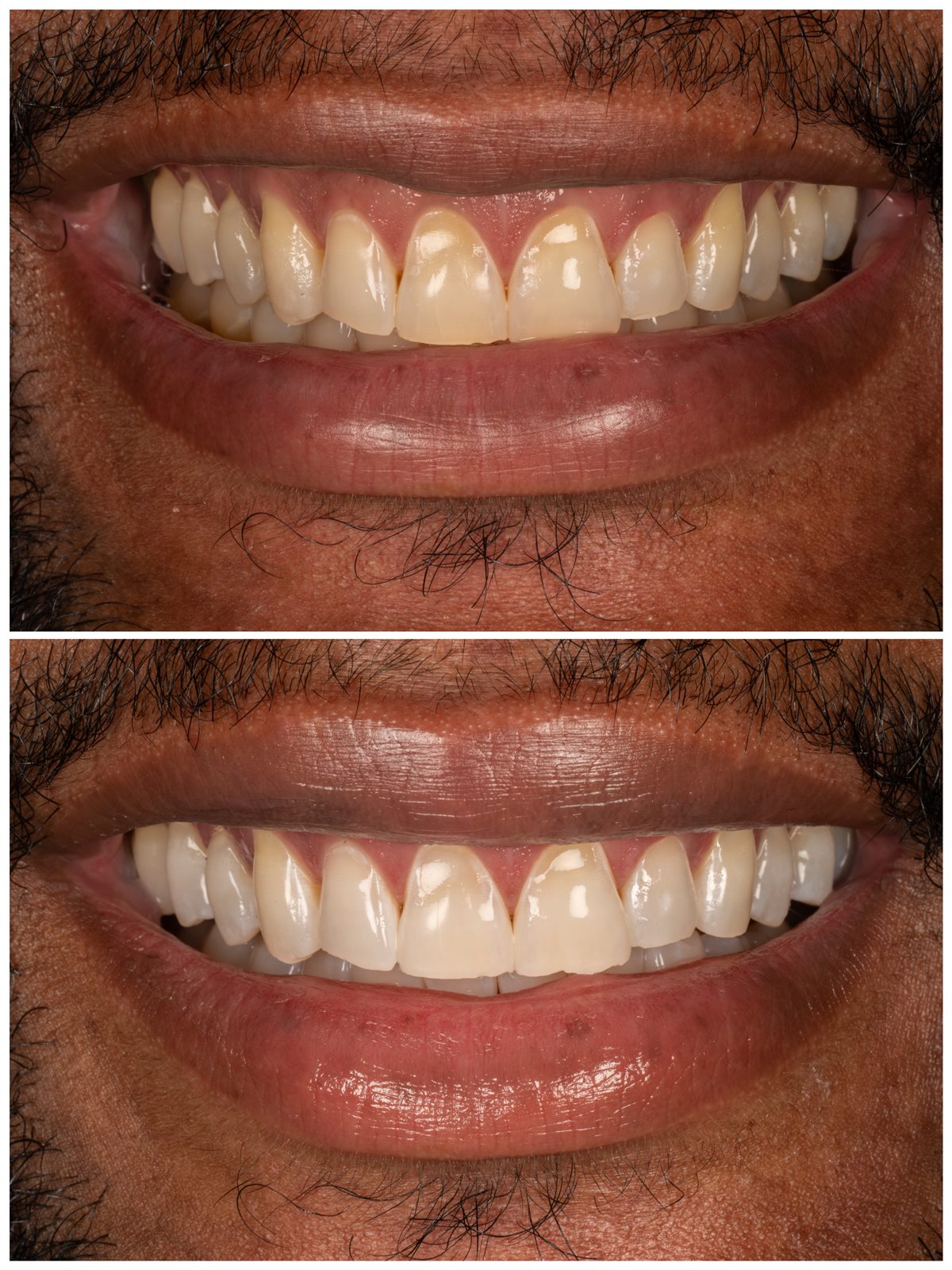 Before and after teeth whitening result