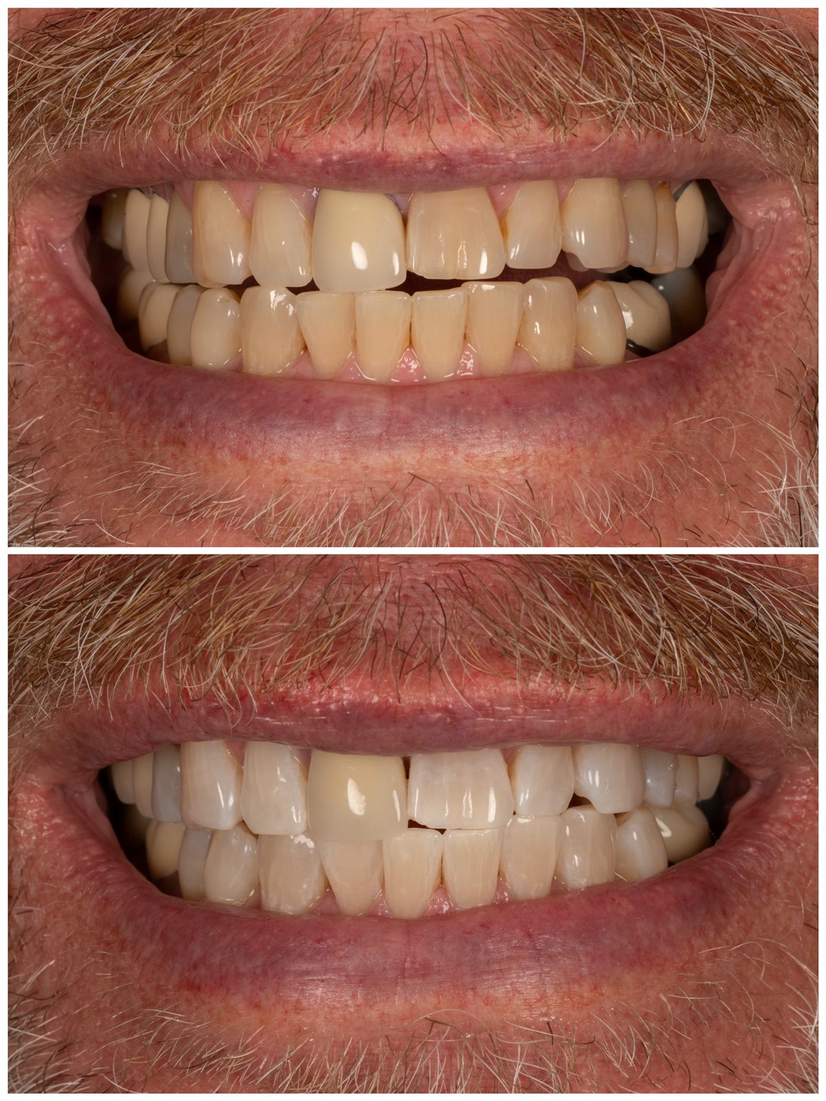 Second before and after teeth whitening result