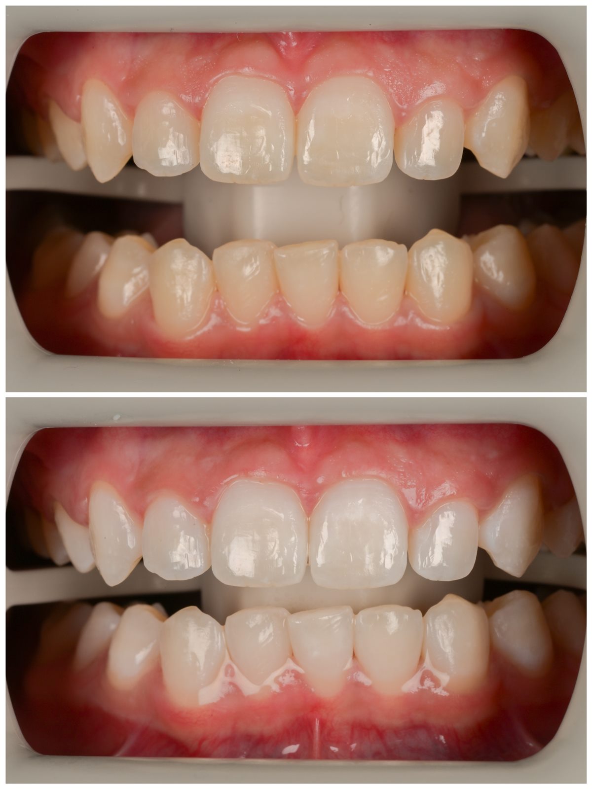 Third before and after teeth whitening result
