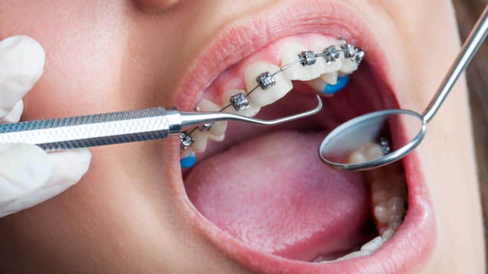 adults orthodontics