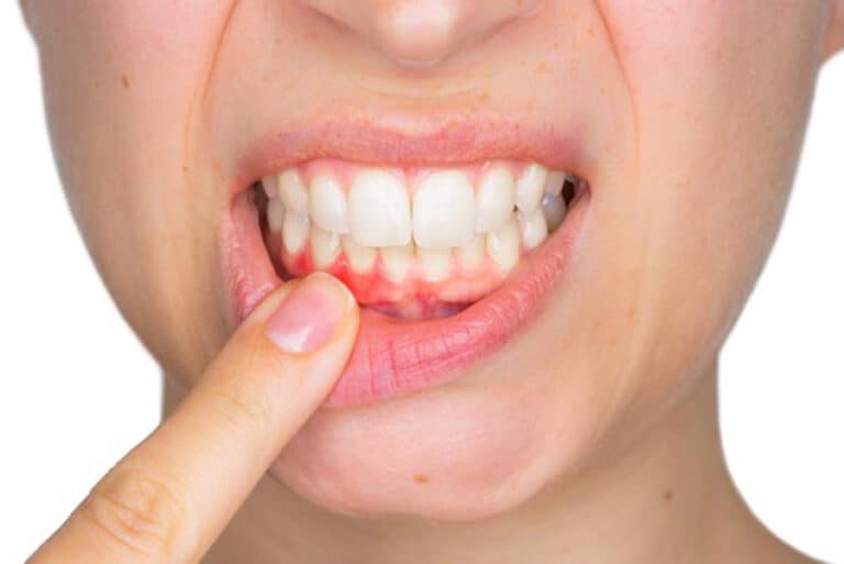Gingival Recession