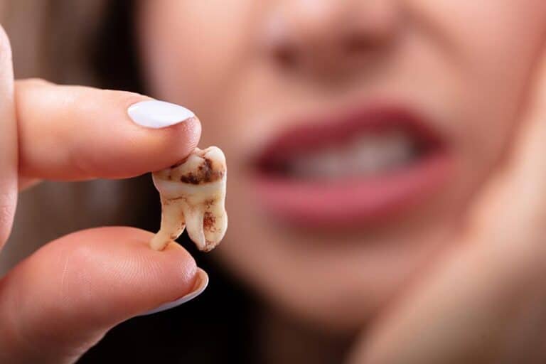 Woman is showing a decayed tooth