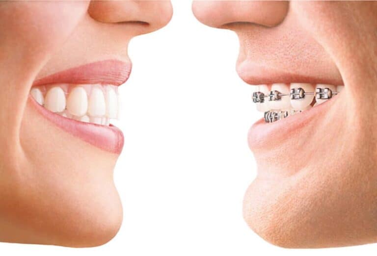 Patient wearing invisalign vs other one with metal braces