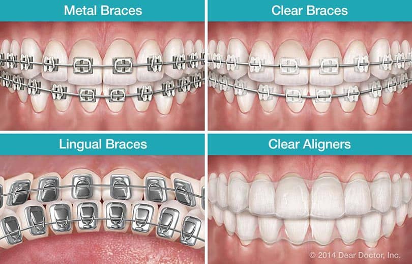 Types of Dental Braces: Metal, Lingual, Ceramic & Invisalign