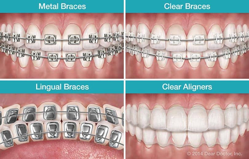 Types Of Dental Braces Metal Lingual Ceramic Invisalign Thompson 