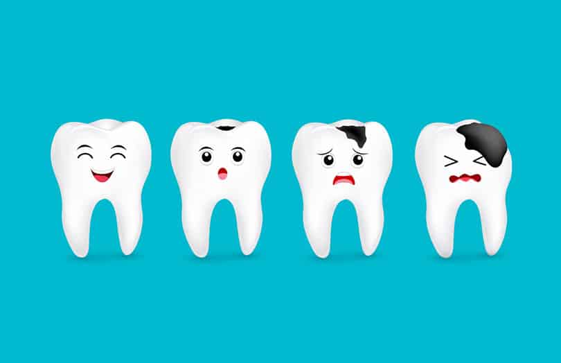 Graphical stages of tooth decay