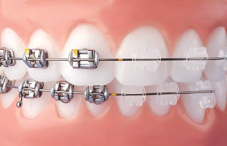 Clear vs metal braces