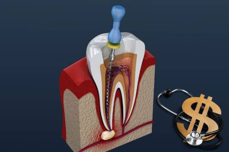 Root canal graphical image and dollar sign