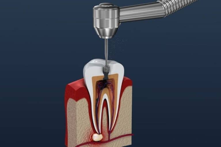A tooth and root canal treatment on it