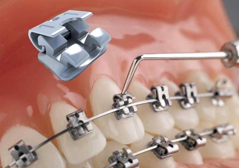 Opening an orthodontic bracket