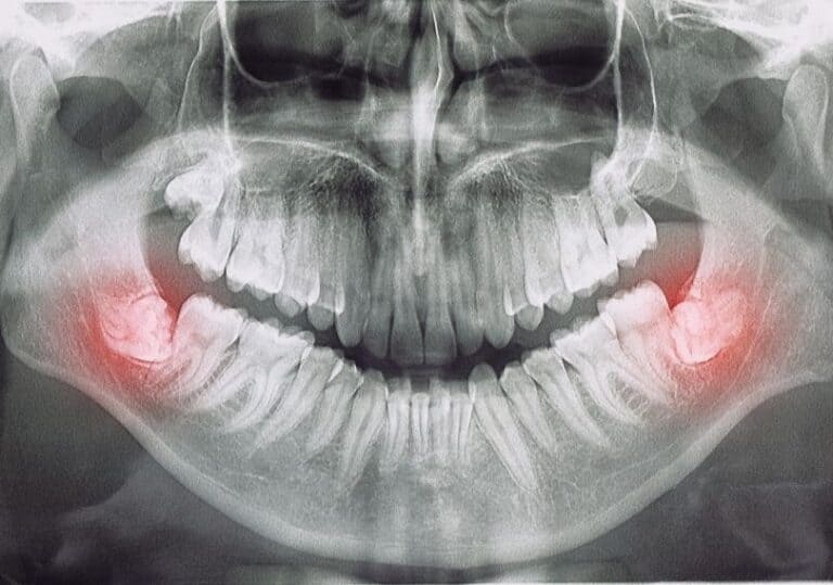 X-ray image from teeth and problem with wisdom teeth