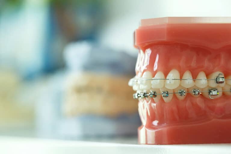 A denatl model wearing braces