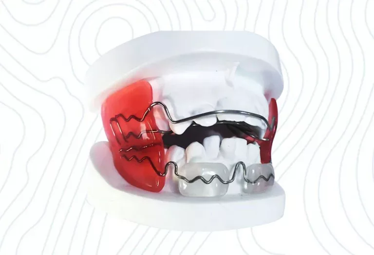 Orthodontic appliance on a dental model