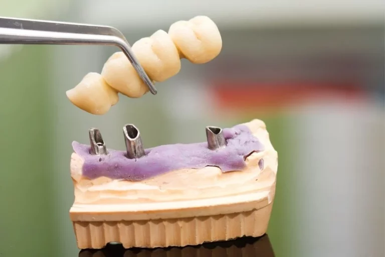 Dental implant head and bridge