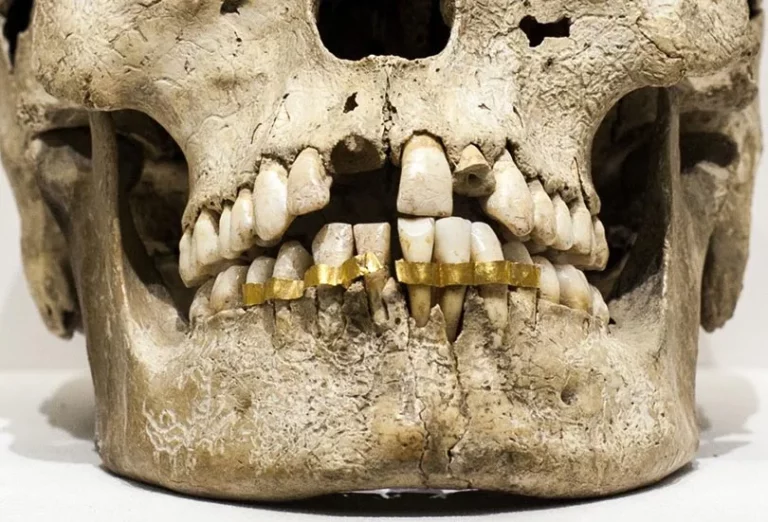 Human skull wearing ancient braces