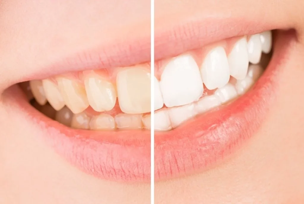 How Much Does Teeth Whitening Cost by Dentist